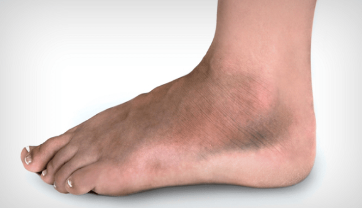 Cách Trị Thâm Mắt Cá Chân